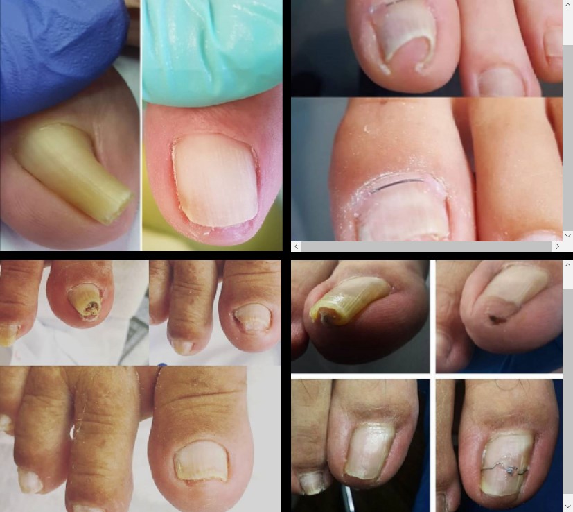 nail surgery Archives - Sports and Structural Podiatry - Maroochydore