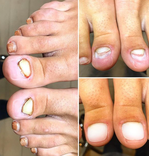 7 Myths about Ingrowing Toenails - Sports and Structural Podiatry -  Maroochydore